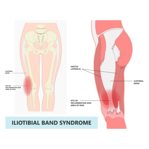 IT-Band-Pain-Mana-Physical-Therapy-Lake-Como-East-Brunswick-NJ